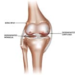 Osteoarthritis